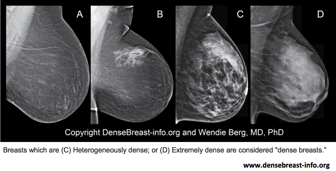 Why Breast Density Matters