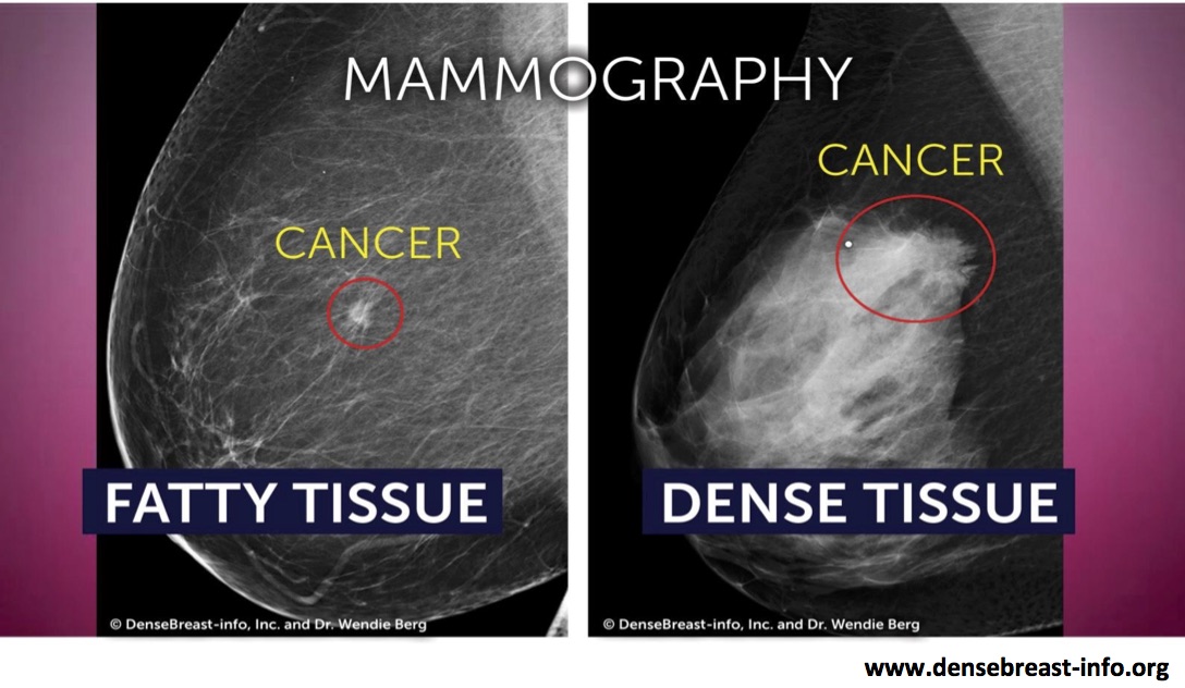 What Does It Mean to Have Dense Breast Tissue? 